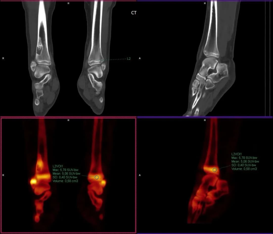 Co to jest SUV max i dlaczego jest kluczowy w diagnostyce?